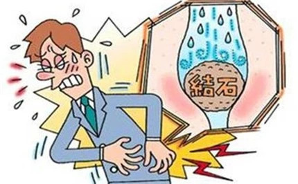 肾结石 那些您需要知道的事儿