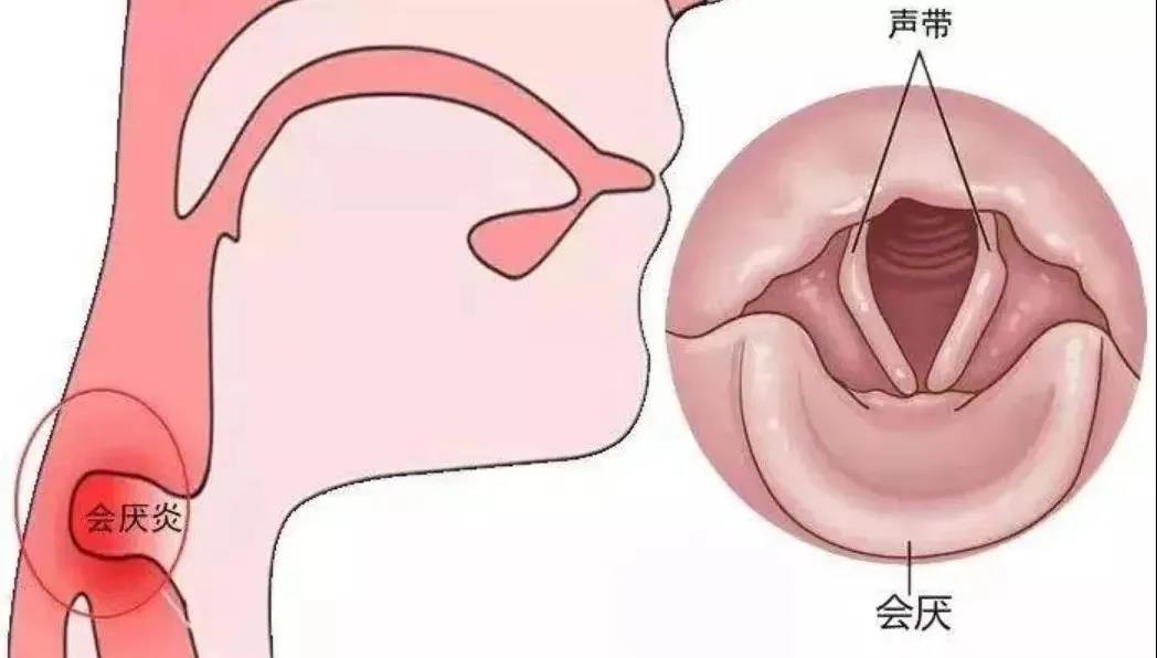 【重要提示】急性会厌炎 不容忽视的致命“咽喉痛”！